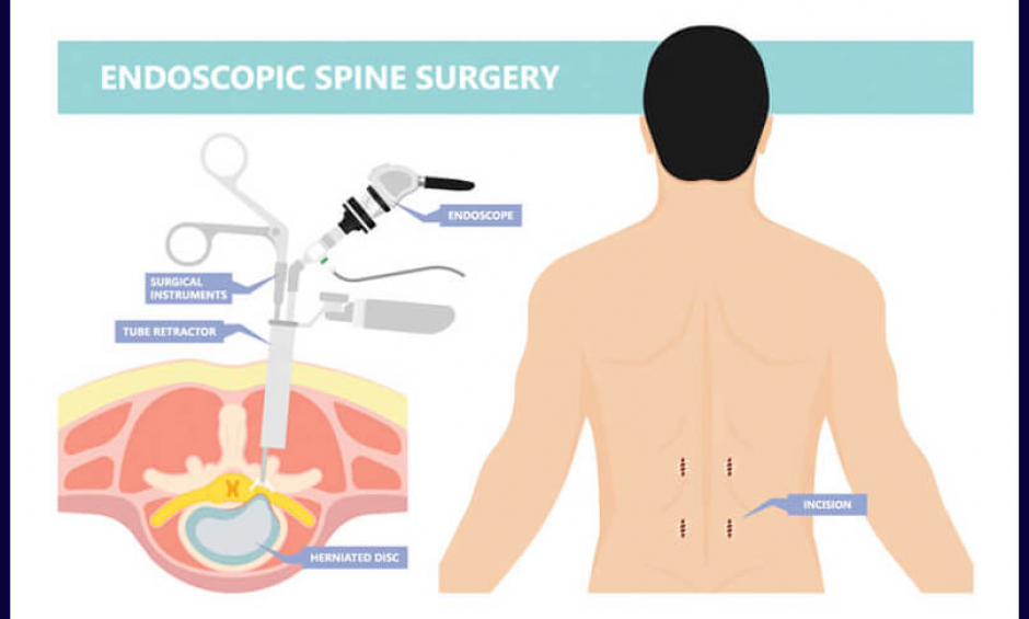 Ενδοσκοπική χειρουργική σπονδυλικής στήλης!