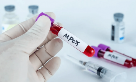 Συναγερμός στην Ευρώπη για την mpox – Σε εγρήγορση ο ΕΟΔΥ – Πως μεταδίδεται και ποιοι κινδυνεύουν!