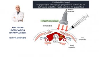Όζοι θυρεοειδούς και παρακέντηση με λεπτή βελόνη (FNA): Τι είναι; Πώς γίνεται;