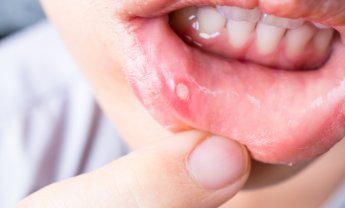 Πως να αντιμετωπίσετε τις άφθες στο στόμα